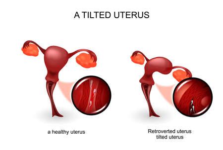 Pain during labor is caused by contractions of the muscles of the uterus and by pressure on the <strong>cervix</strong>. . Cervix tilted to the side